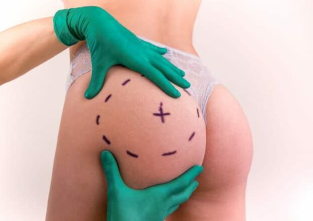 hyacorp-macrolane-difference-pour-gonfler-fesses-625×533