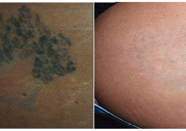 AvAp-tatoo1