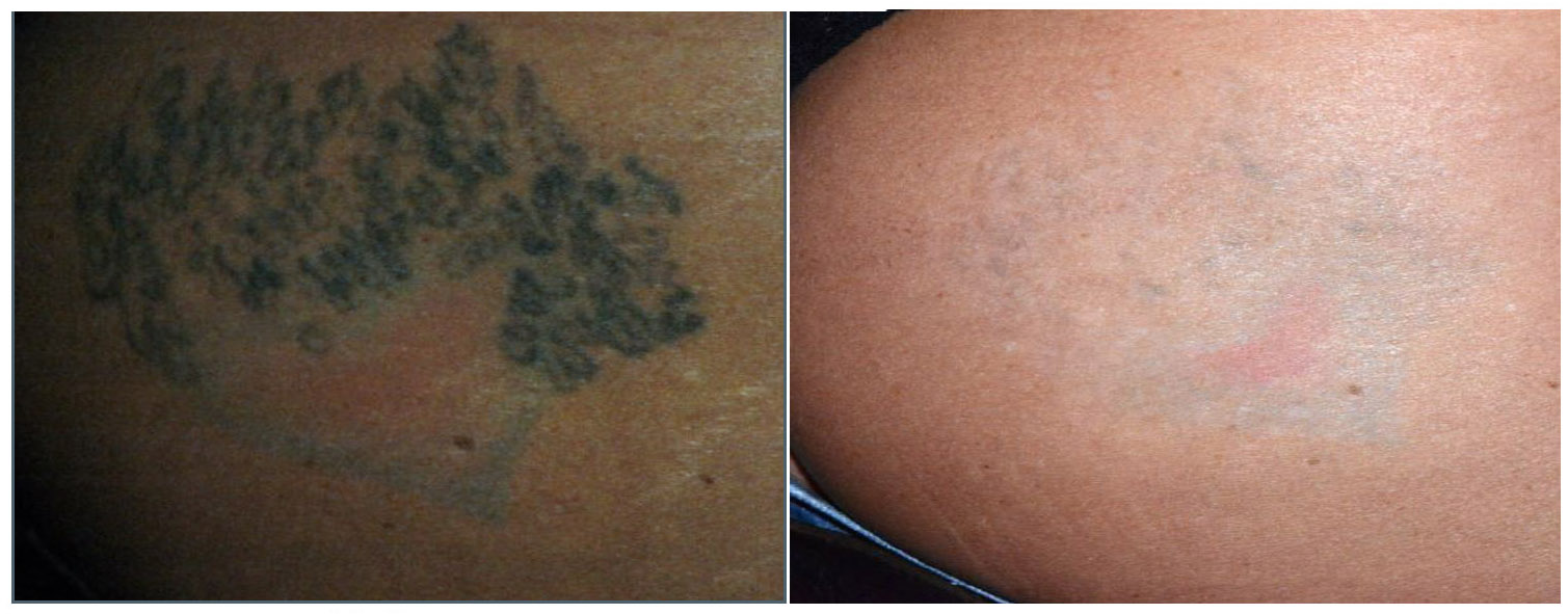 Détatouage avant/après 3 | L’AZ de Longchamp