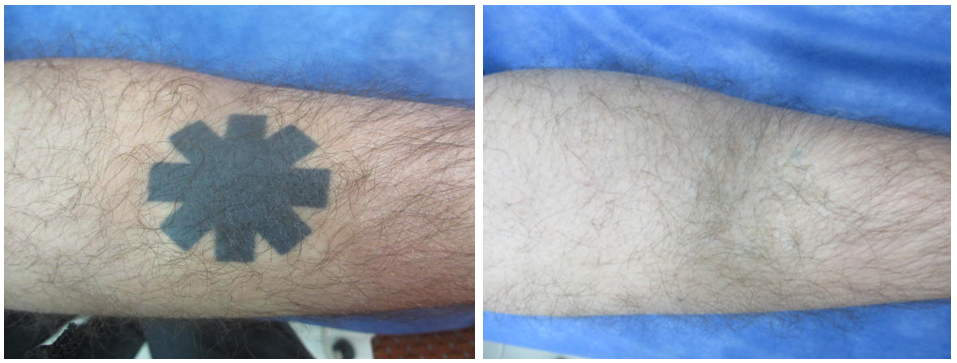 Détatouage avant/après | L’AZ de Longchamp