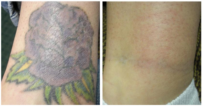 Détatouage avant/après 2 | L’AZ de Longchamp