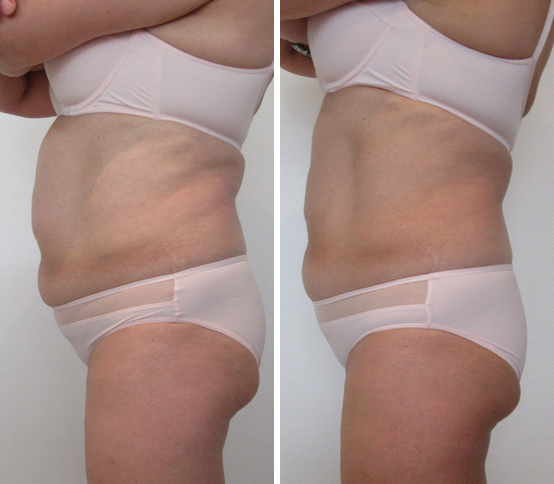 Cryolipolyse avant/après 2| L’AZ de Longchamp