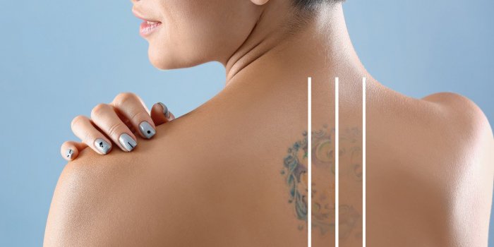 Détatouage résultats | L'AZ de Longchamp